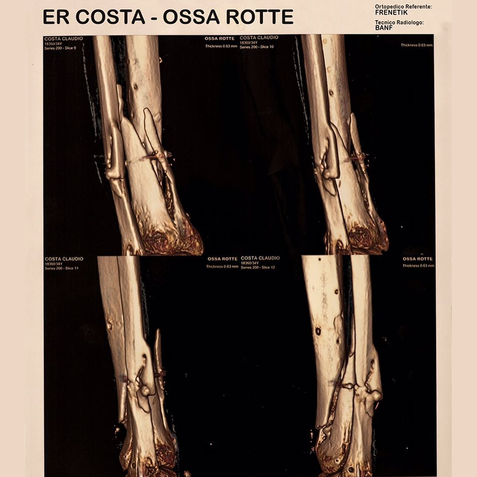 Cover della canzone 'Ossa Rotte' di Er Costa